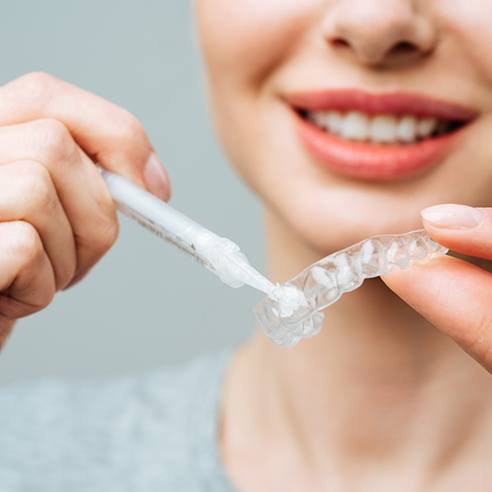 Woman placing whitening gel in custom tray