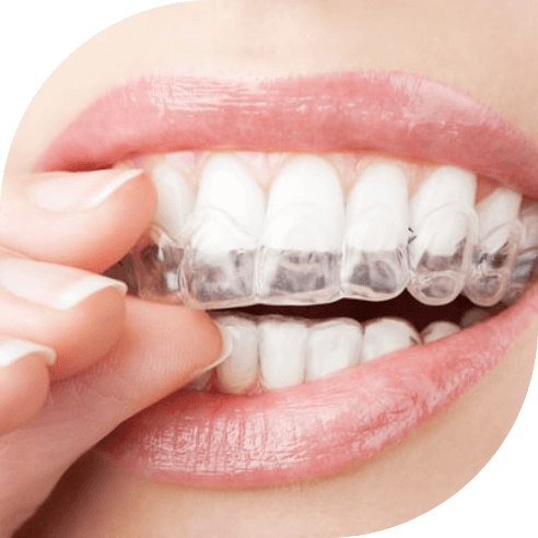 Dental patient placing a take home teeth whitening tray
