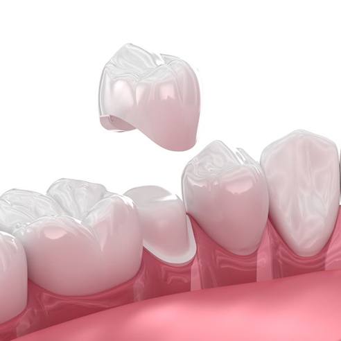 Illustration of dental crown being placed on tooth