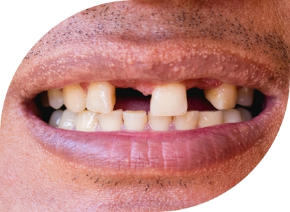 Closeup of smile multiple missing teeth
