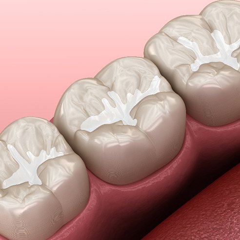 A 3D illustration of tooth-colored fillings