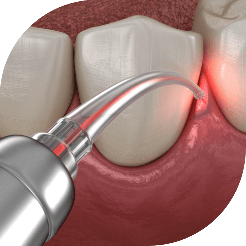 Animated smile during laser periodontal therapy