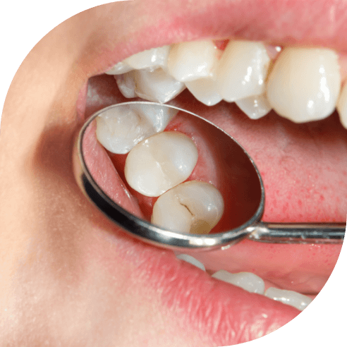 Dentist examining patient's smile after dental sealant placement