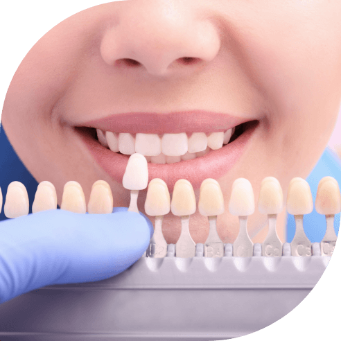 Dental patient's smile compared to tooth colored filling shade options