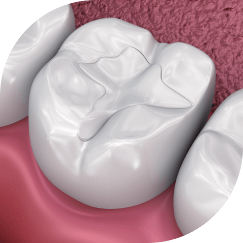 Animated smile with safe composite resin tooth colored filling in place