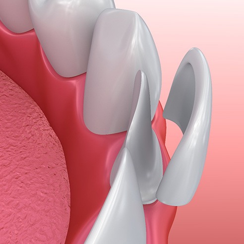 Render of veneers in Albuquerque, NM being placed on teeth