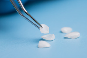 Several veneers on table, one picked up by forceps