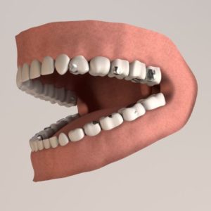 teeth of patient who could benefit from mercury safe dentistry
