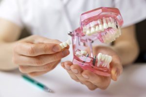 Dentist using model to explain how dental implants work